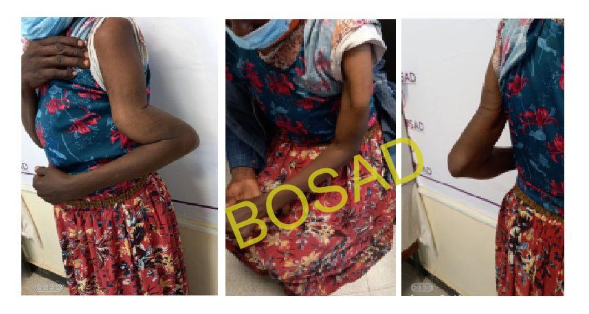 CASE SCENARIO-1 picture without splint